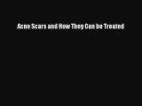 Read Acne Scars and How They Can be Treated Ebook Online