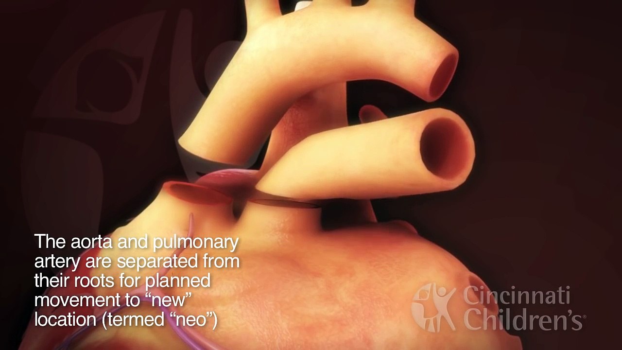 Arterial Switch Operation for Transposition of the Great Arteries | Cincinnati Childrens