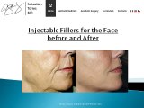 Injectable Fillers for The Face Before and After
