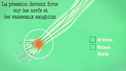 Vous êtes voûté(e) au travail ? Voilà pourquoi la posture de la tortue est mauvaise