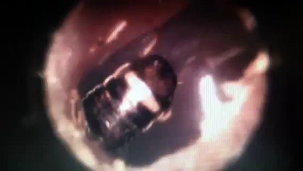 Dead cockroach in the ear of a one year old child, incident