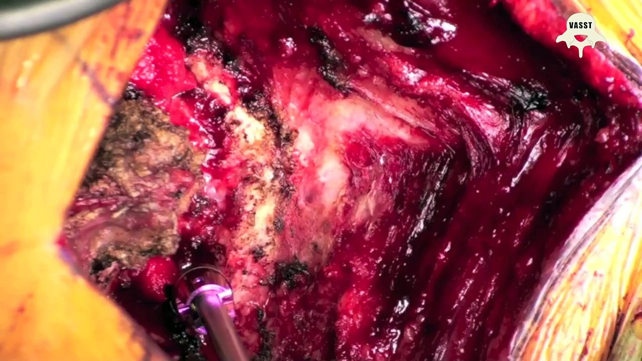 Video Atlas of Spine Surgical Techniques