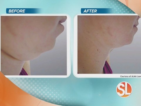 North Valley Plastic Surgery offers non-surgical body contouring with V-Shape