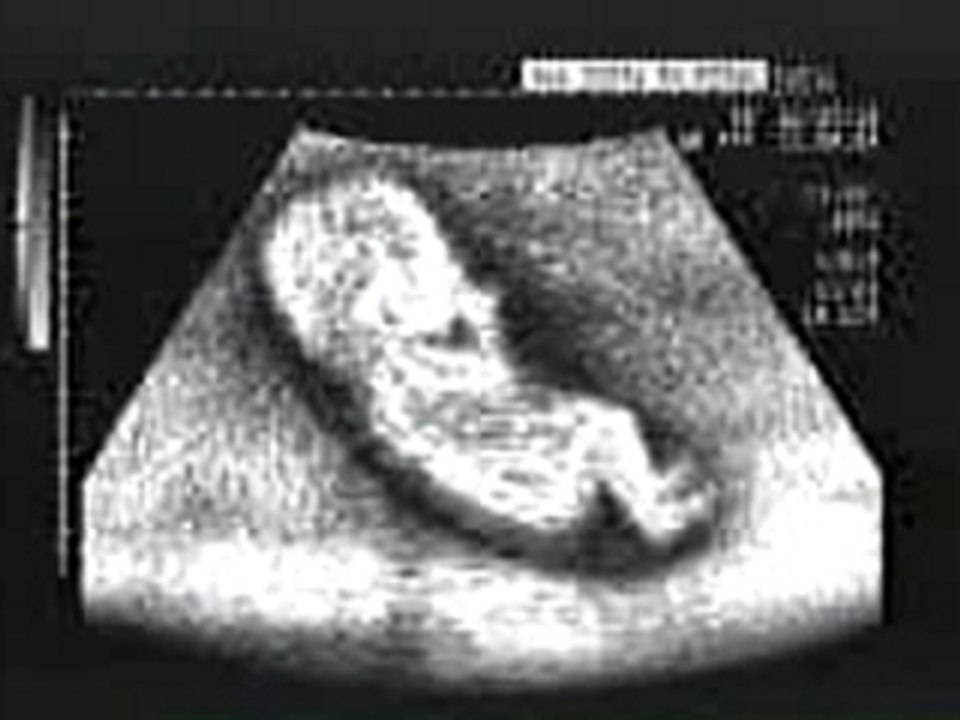 Echographie