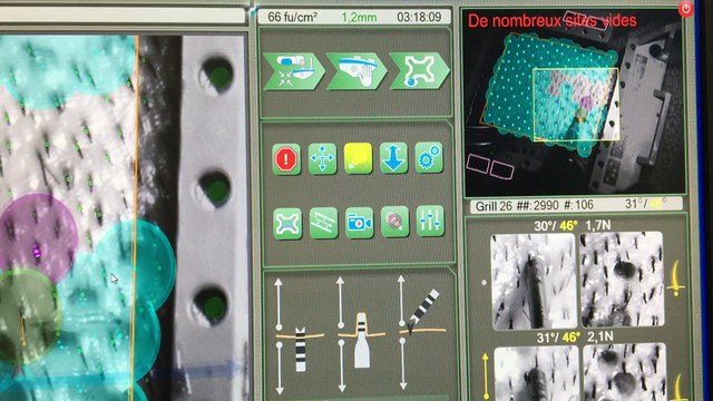 3000 greffons prélevés en 3h18 mn