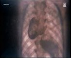 Dextrocardia: Cilios y genes
