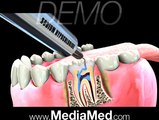 Root Canal Treatment