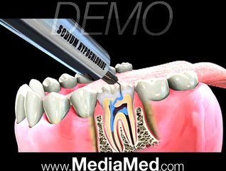 Root Canal Treatment