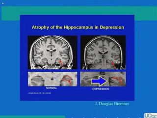 The Biology of Depression The Affects of Stress 20