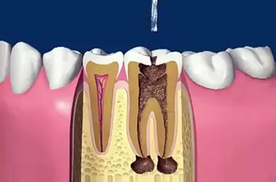 Aftermath wisdom teeth (must watch till end)