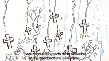 Un implant pour éviter la maladie d’Alzheimer