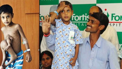 8 People With Extra Body Parts