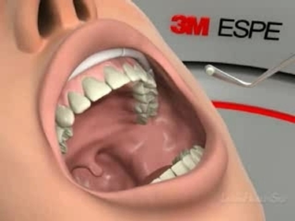 Composite_anterieur