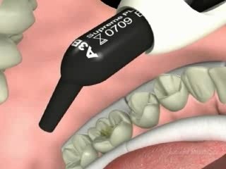 Comprendre le Composite Postérieur : Symptômes, Causes et Traitements 🩺
