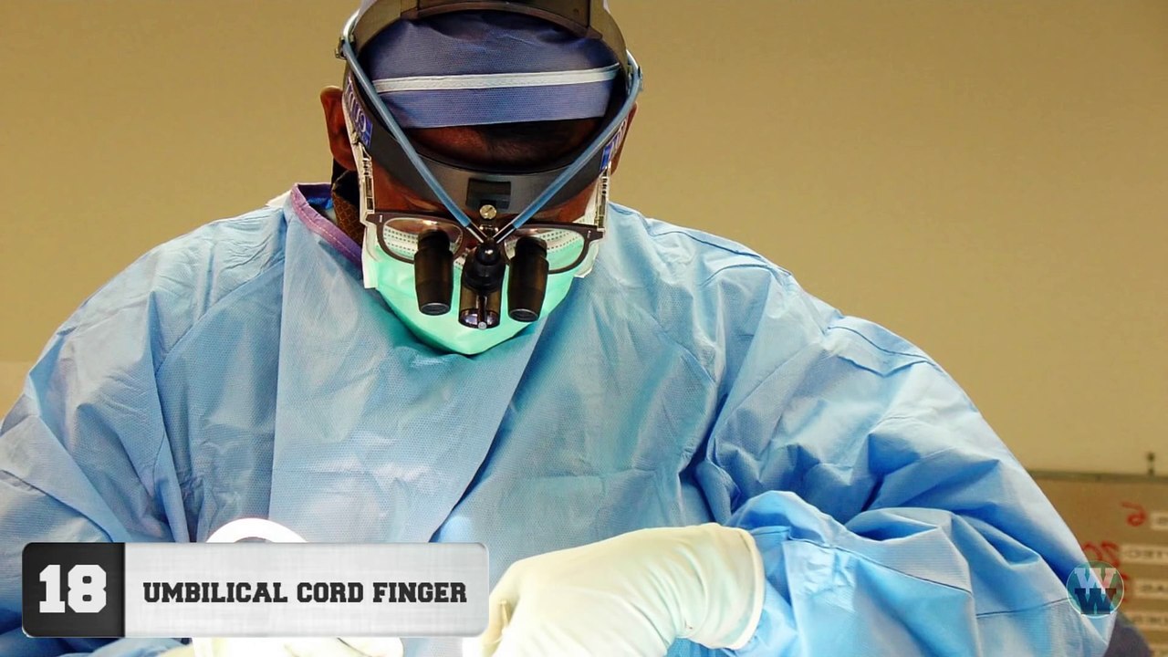 20 Bizarre People With Extra Body Parts