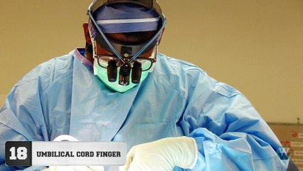 20 Bizarre People With Extra Body Parts