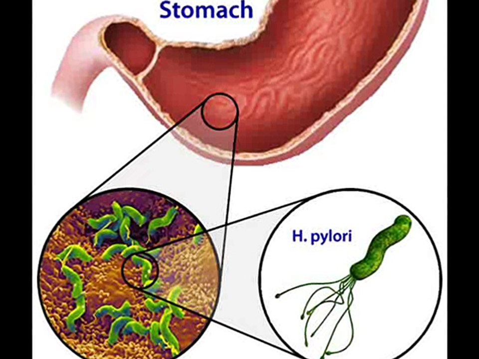 Secondary line helicobacter pylori treatment includes histamine blockers to regulate acid secretion