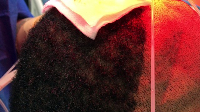 Prelevement ARTAS sur cheveux incurves AFRO