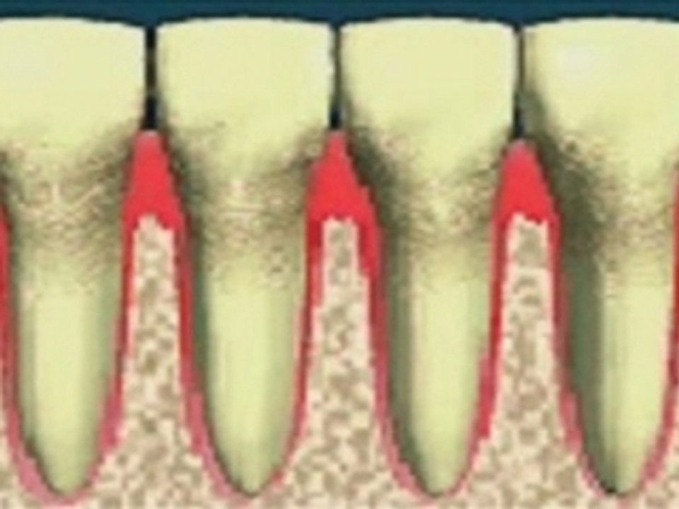 Dechaussement des dents