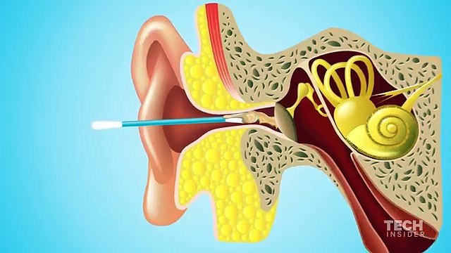 Perchè i cotton fioc sono dannosi per la pulizia delle orecchie.