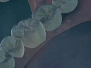 Inlay Onlay esthétiques