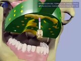 Rehabilitación de un implante dental