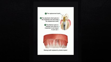 Dental Implants Austin TX | Call Us: (512)379-5752