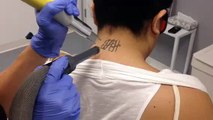 Neck Tattoo Removal of Initials