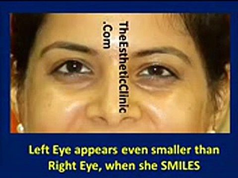 Dark Circles under Eye Treatment in Mumbai - The Esthetic Clinics