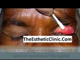 Eyelid Cancer Surgery in Mumbai_ India - The Esthetic Clinics