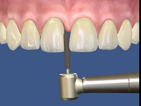 Виниры для закрытия диастемы