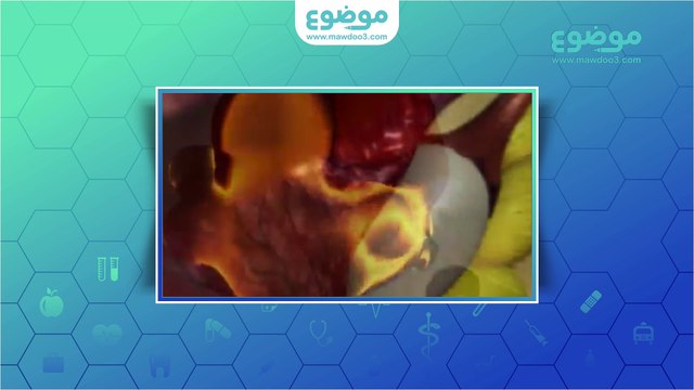 متلازمة تكيس المبايض