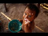 children malnutrition in department of La Guajira