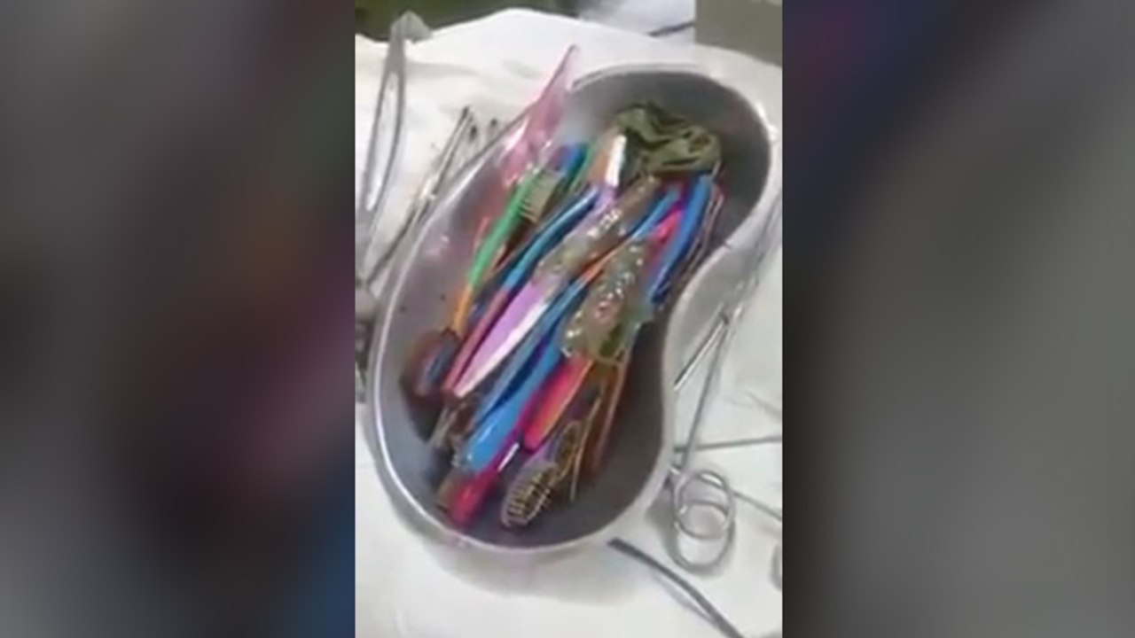 Ce patient avait 18 brosses à dents dans l'estomac