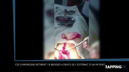 Ces chirurgiens retirent 18 brosses à dents de l’estomac d’un patient, la vidéo choc !