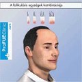 Hajbeültetés, hajátültetés animáció -- 6/8 | www.ProFUEClinic.com