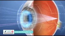 Lasik Eye Surgery Chennai - Blurred Vision in Tamilnadu