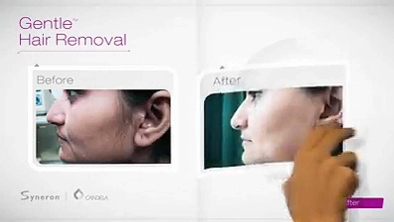 Laser Services at HARPE Laser + Wellness