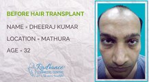 Hair Transplant Before and After Testimonials
