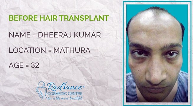 Hair Transplant Before and After Testimonials