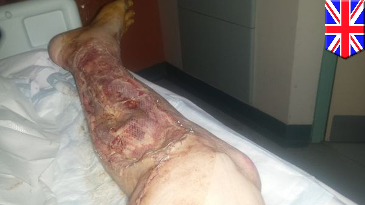 Flesh-eating disease ruins man's life a second time