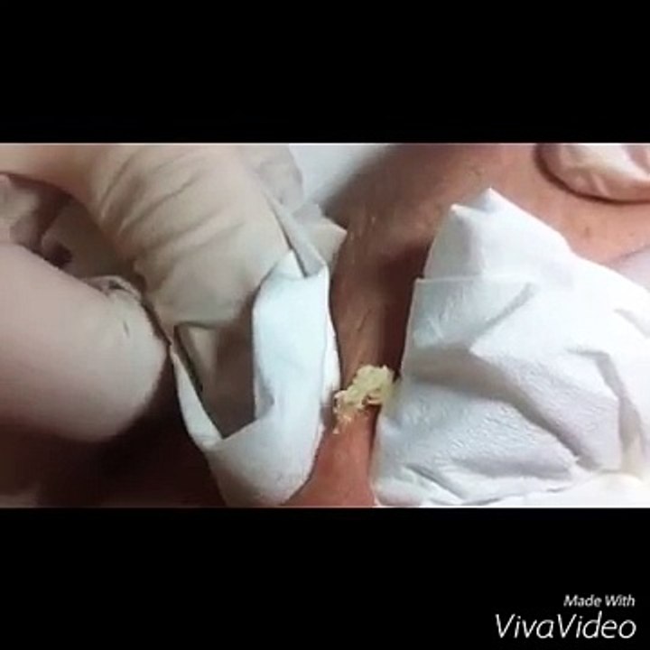 BULTO INTERNO DE PUS