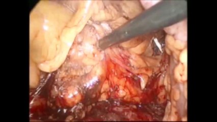 Laparoscopic transverse colectomy by Dr. M. Mahfouz