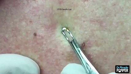 Un énorme boutons dans le dos