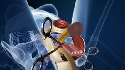 Opération de changement de sexe en 3D