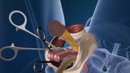 Opération de changement de sexe en 3D