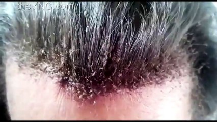 Amigo tiene la cabeza llena de piojos!