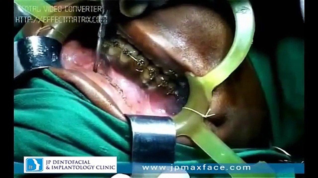 Modified Lefort Osteotomy Kerala, Rhinoplasty Surgery