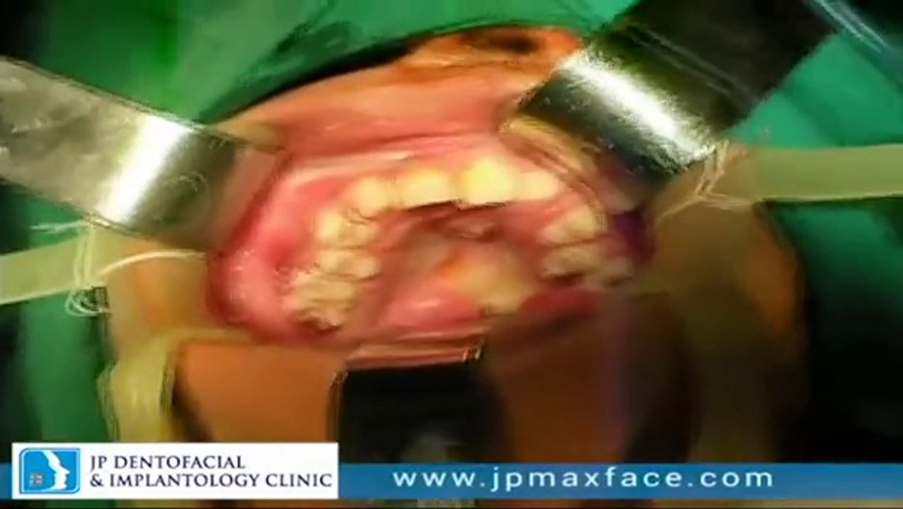 Maxillary Surgery Kerala, Dental Clinic Thrissur