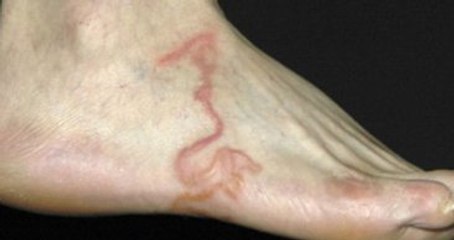 Ayağında Beliren İzleri Varis Sanan Adamın Cildinde Parazit Çıktı